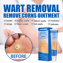 Natürliche 20g Warzenentfernungssalbe für Hühneraugen und Schwielen, Vielseitig einsetzbar