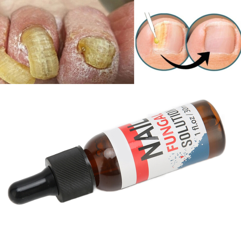 Fungal Nail Renewal Nail Fungus Treatment 30ml Nail Repair Liquid