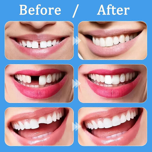 DIY Temporary Tooth Repair Kit with 4 Dental Tools for Broken or Chipped Teeth 1