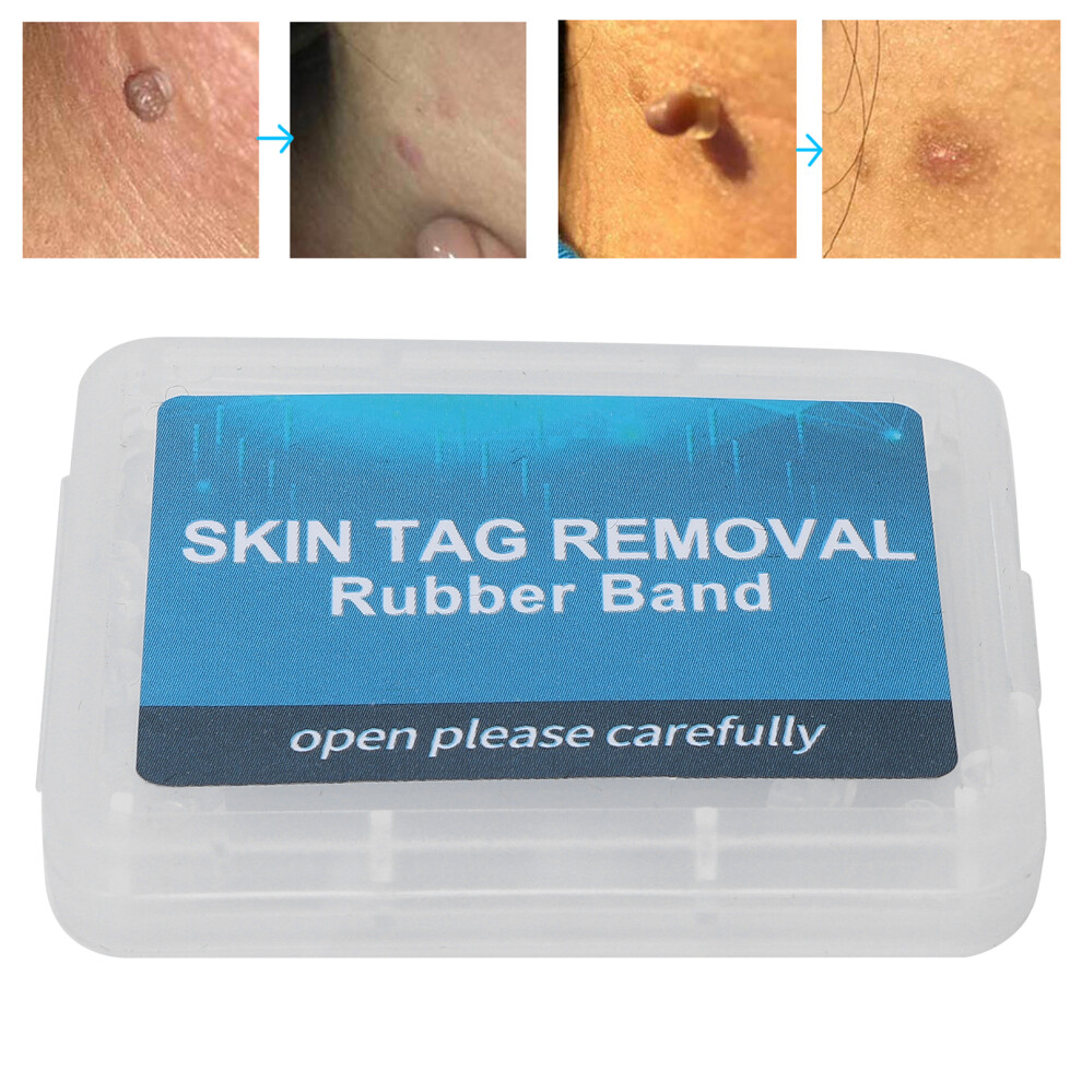 30Pcs Skin Tag Removal Rubber Bands Safe Micro Band Non Toxic Mole Wart Skin