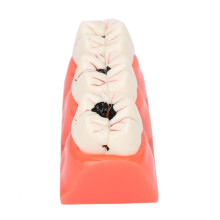 Dental Caries Tooth Decay Demo Model with Detachable Teeth for Dental Education