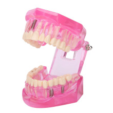Transparent Adult Dental Teeth Model for Teaching & Demonstration