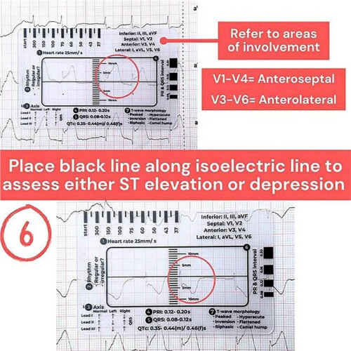 40 Pezzi ECG 7 Step Ruler, ECG 7 Step Ruler per Interpretazione ECG/EKG, ECG Reference Guide Ruler, EKG Calipers Measuring Tool 2