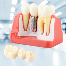 Resin Dental Implant Tooth Model for Education & Demonstration