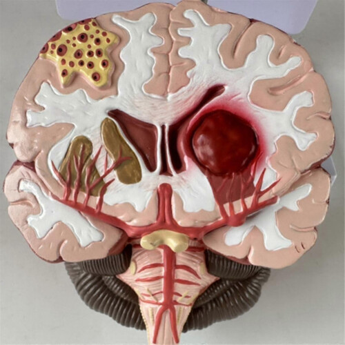 Human Brain Disease Model - Brain Pathology Brainstem Hemorrhage Medical Teaching Model - Human Bra 1
