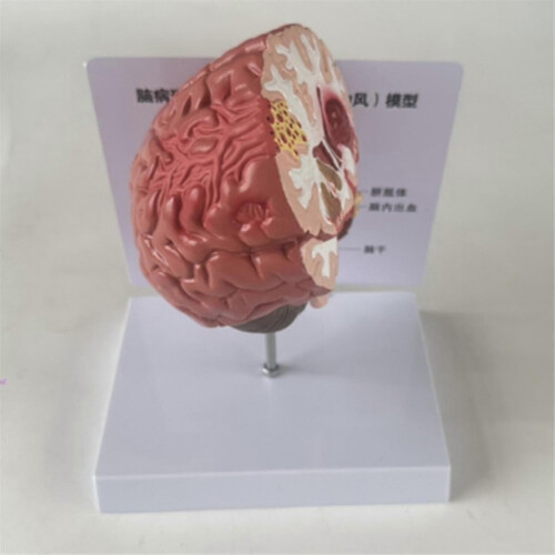 Human Brain Disease Model - Brain Pathology Brainstem Hemorrhage Medical Teaching Model - Human Bra 2