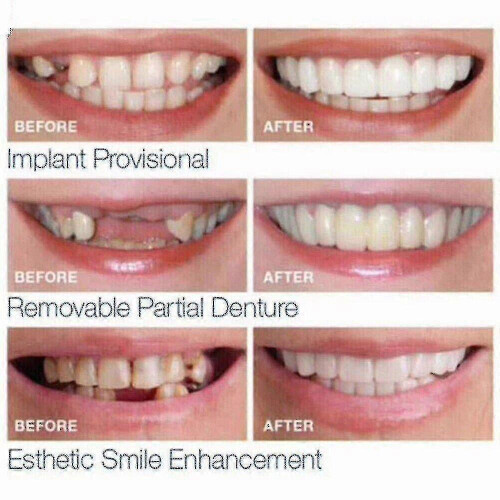 Upper Lower Dental Veneers Dentures - Snap On False Teeth for A Perfect Smile 1