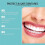 Veenora Clip-On Veneers, Adjustable Snap-On Teeth 2
