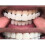 (Lower teeth)Upper/lower Comfort Fit Flex Whitening Denture Braces - Pjun 3
