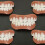 5pcs Set Upper Teeth   Lower Teeth   Transparent Case   Accessories. Not a Dental Veneer Kit. Suitable for Missing or 2