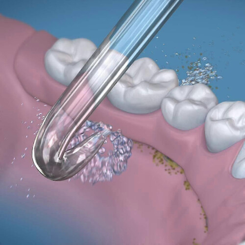 2 Replacement Tips for Implant Dentures 1