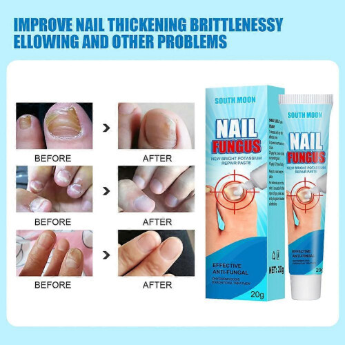 Fungal Nail Treatment Liquid HIGHLY EFFECTIVE KILLS TOE NAIL 1