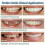 Perfect Smile Tooth Cover Snap On Upper Bottom False Teeth Dental Veneer Denture Set 5