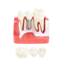 (Red) Implant Model Crown Bridge Demonstration Class Education Studying Teeth Model