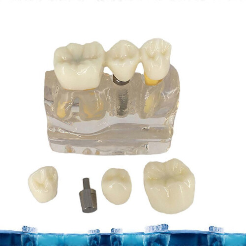 (Red) Implant Model Crown Bridge Demonstration Class Education Studying Teeth Model 2