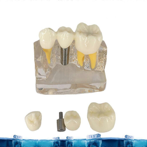 (Red) Implant Model Crown Bridge Demonstration Class Education Studying Teeth Model 2