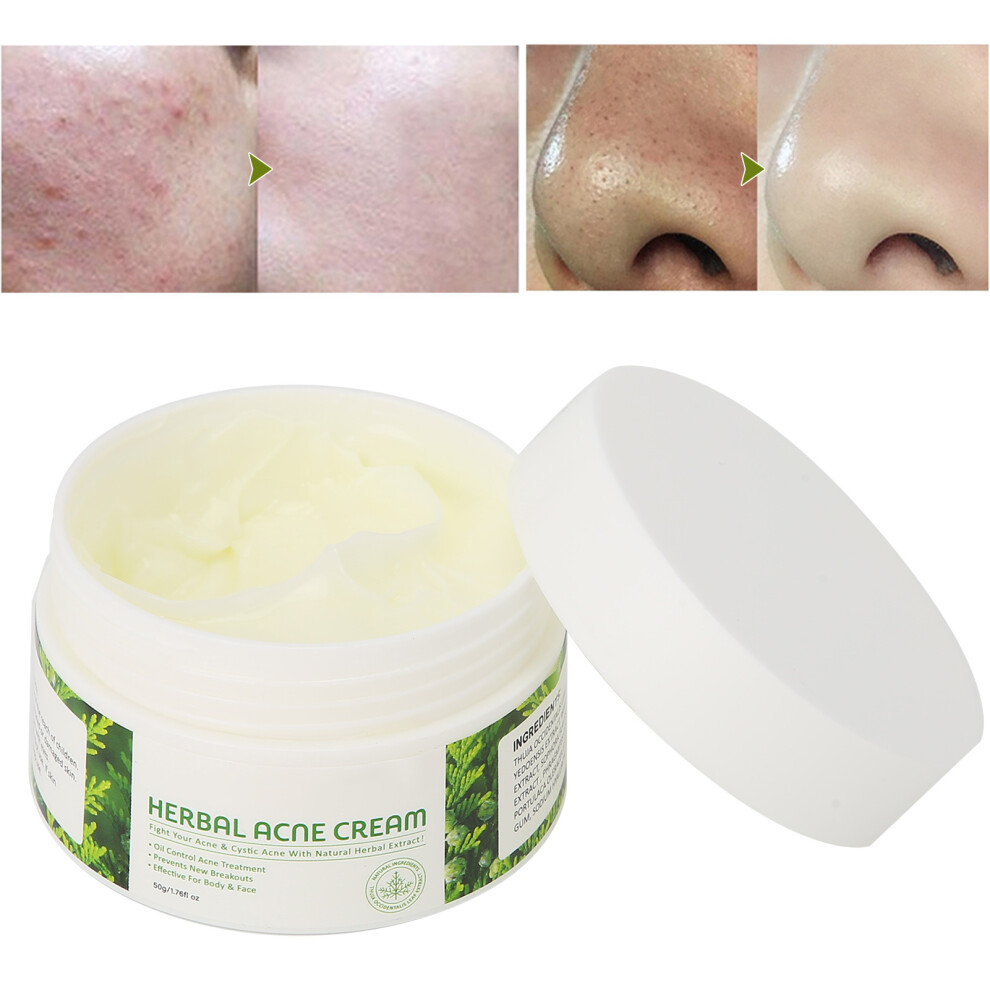 Cream Acne Removal 50 G Plant Extraction