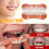 5pcs Set Upper Teeth   Lower Teeth   Transparent Case   Accessories. Not a Dental Veneer Kit. Suitable for Missing or 3