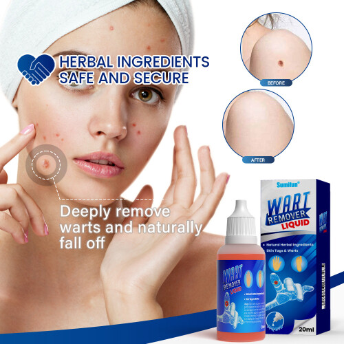 Solution d'élimination des verrues, solution de soins de la peau, aplatissement des verrues, élimination des cors, solution 2
