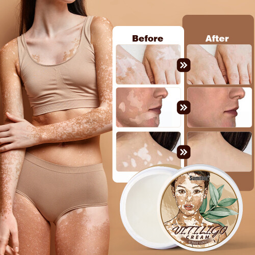 White Spot Cream Skin Care 1