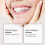 1Box Advanced Customized Full Denture Set, Silicone Reline for Comfort & Natural Smile 5