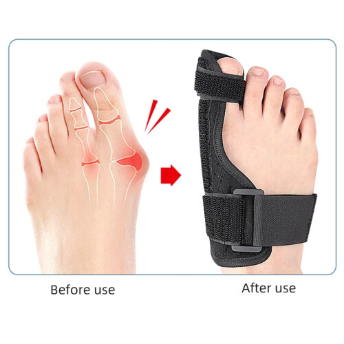 Bunion Corrector for Left Foot, Adjustable Hallux Valgus Splint with Toe Alignment Support and Flannel Padding, 2PCS 2