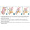 Hernia Belt XLarge for Men, Adjustable Inguinal Hernia Support Truss with Dual Compression and Removable Pads 5