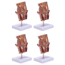 4X Anatomie Model Menselijke Rectale Aambei Laesie Model Aambei Fistel Fistel Kloof Pathologie Onderwijs Model