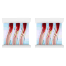 2X Dynamic Blood Vessel Model Cardiovascular Blockage Contrast Model Thrombosis Model for Teaching Explanation