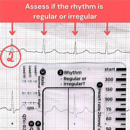 4pcs ECG 7 Step Ruler,ECG 7 Step Ruler for ECG/EKG Interpretation,ECG Reference Guide Ruler,EKG Calipers Measuring Tool 2