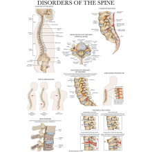 Palace Learning Disorders of the Spine Anatomy Poster - Laminated Spinal Disorders Anatomical Chart - 18" x 24"