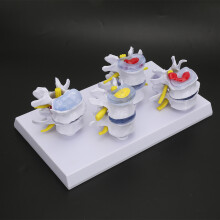 4-stage Lumbar Vertebrae Models, 1 set, PVC, color