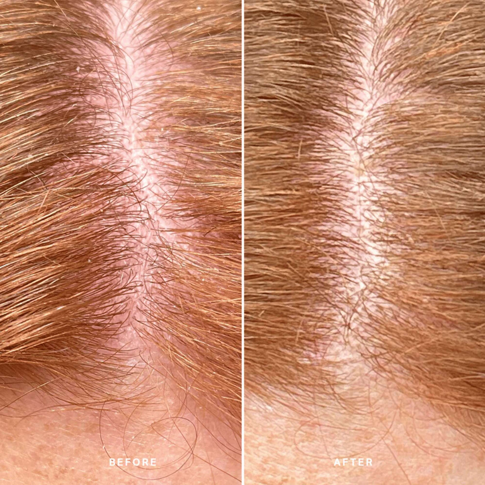 Alpha-H Healthy Scalp Exfoliating Treatment 100Ml - Image 6