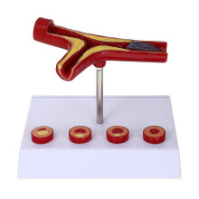 Modelo médico de aterosclerosis Modelo anatómico de vasos sanguíneos Modelo cardiovascular
