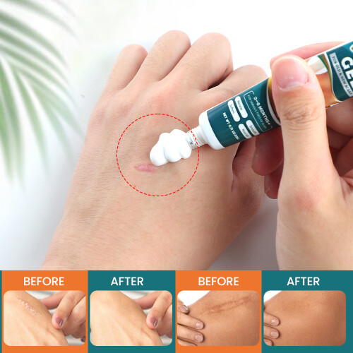 Scar Health Cream Topical Cream 1