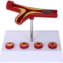 Atherosclerosis Model 10x Enlarged FourStage Human Artery Anatomy Educational Display Durable Teaching Tool