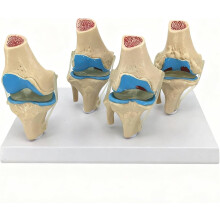 Four Stage Knee Joint Anatomical Model Set for Medical Teaching, Detailed Osteoarthritis Pathology Display