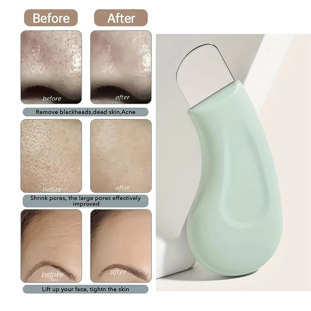 Blackhead and Whitehead Removal Tool for Nose and Face - Skin Pore Cleaner
