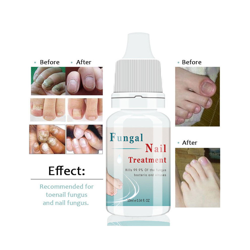 10Ml Fungal Nail Treatment Liquid - Effective For Toenail Fungus Care 413590203025