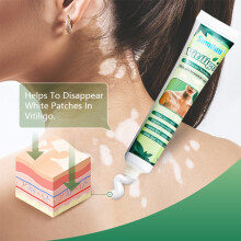 20G Vitiligo Care Cream for Skin Vitiligo Psoriasis Leukoplakia Reduce Spot