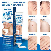Wart Removal Cream Filiform Warts Body Flat Wart Cream Mole Pointing Cream