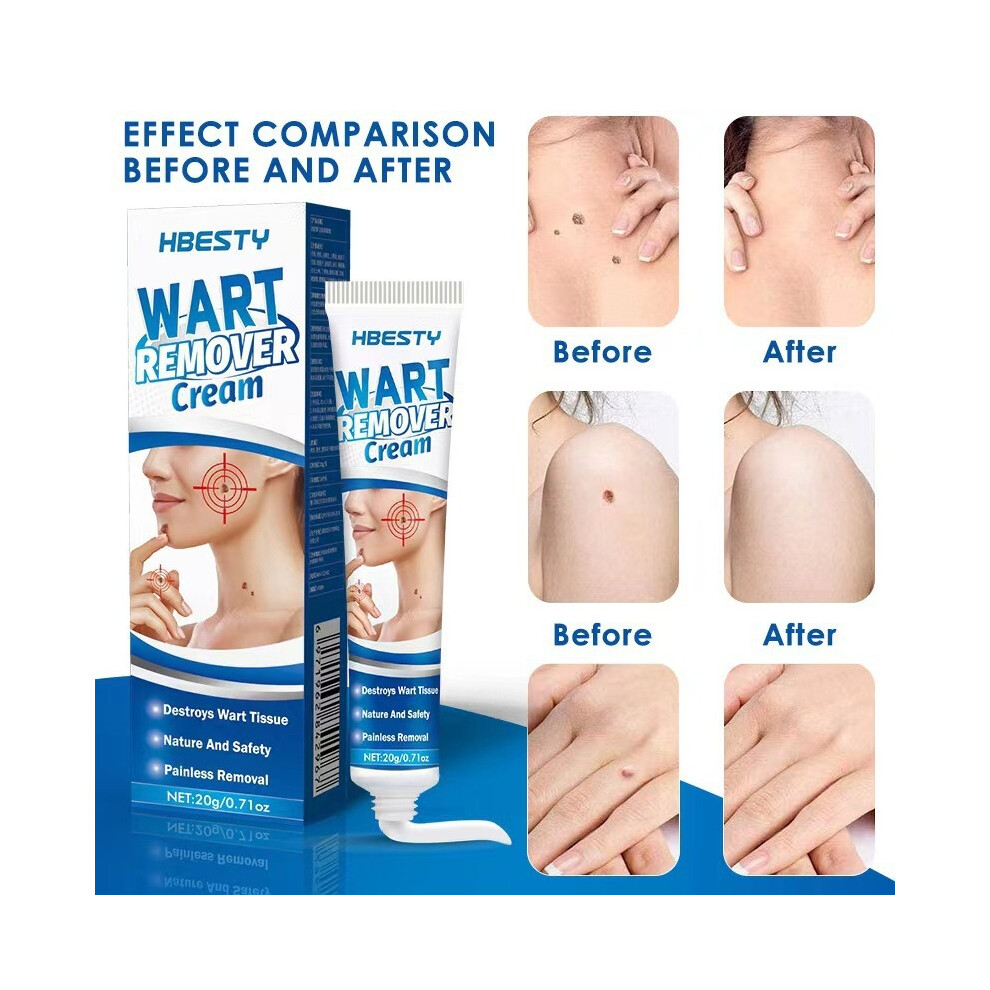 Cream Wart Removal Filiform Warts Body Flat Wart Mole Pointing