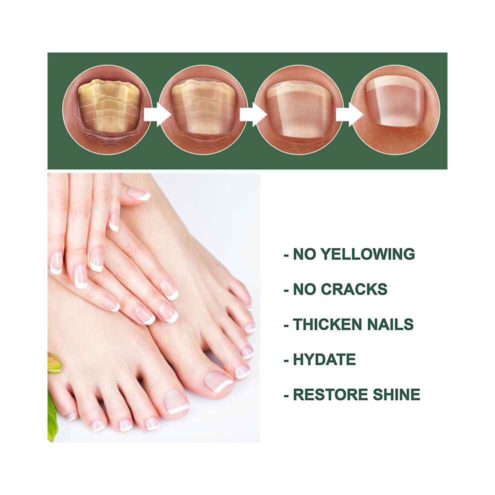 (50ml) 30/50ML Nail Fungal Treatment - Antibacterial Solution for Toe & Finger Fungus Infection