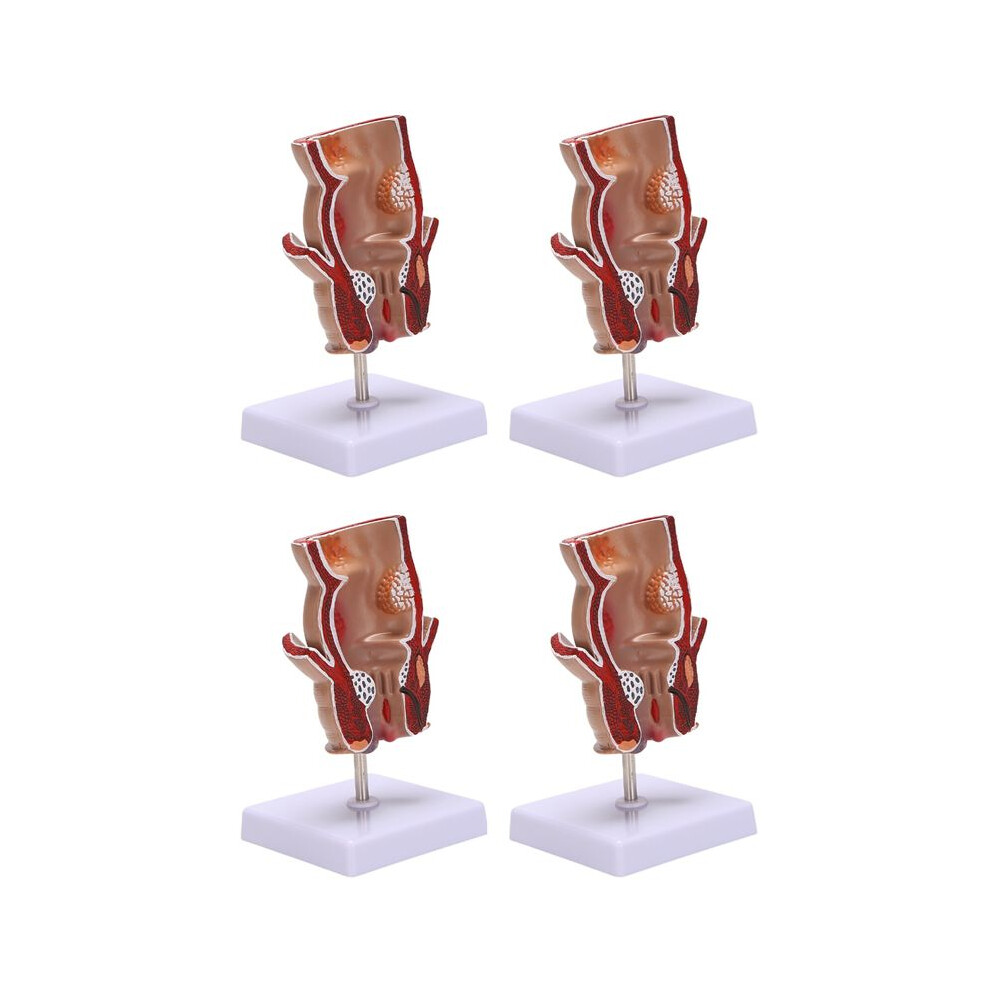 Unisex 4X Anatomy Model Human Rectal Hemorrhoid Lesion Model Hemorrhoid Fistula Fistula Fissure Pathology Teaching Model