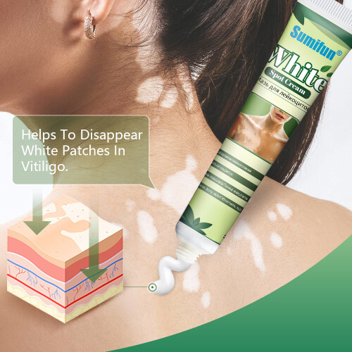 Creme Vitiligo Creme para Cuidados com a Pele 2