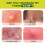 Gel de limão para pele, bálsamo para cuidados com acne 4