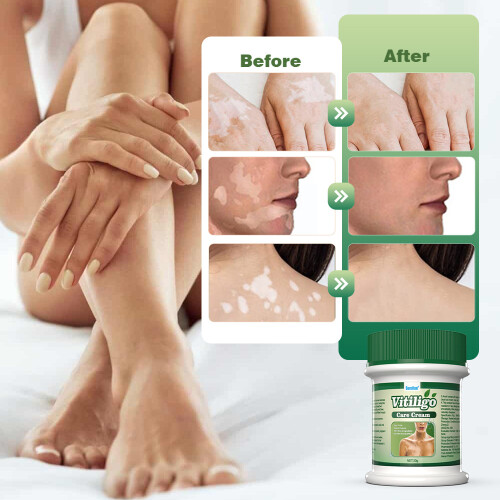 Creme para manchas brancas creme para cuidados com a pele 2