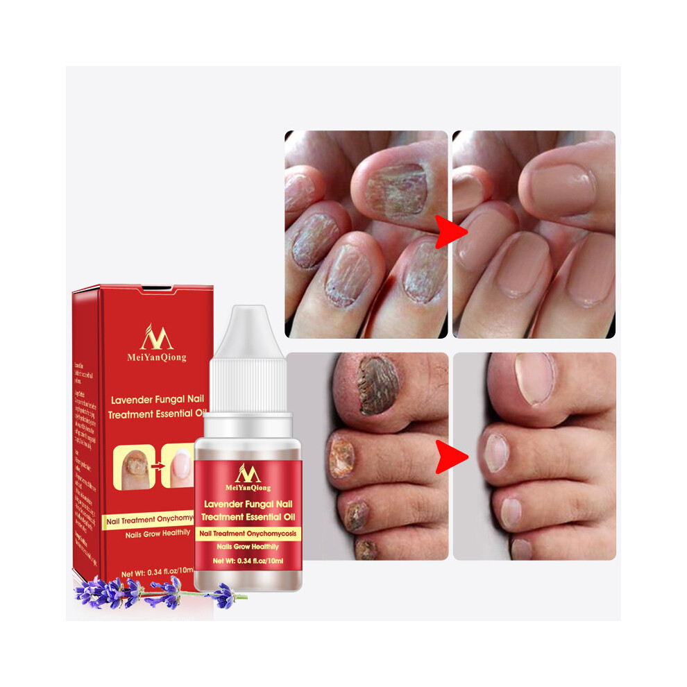 Lavender Fungal Nail Treatment Serum Onychomycosis Paronychia Anti-Fungal Nail Infection Herbal Toe Fungus Foot Repair Essence Care 10Ml