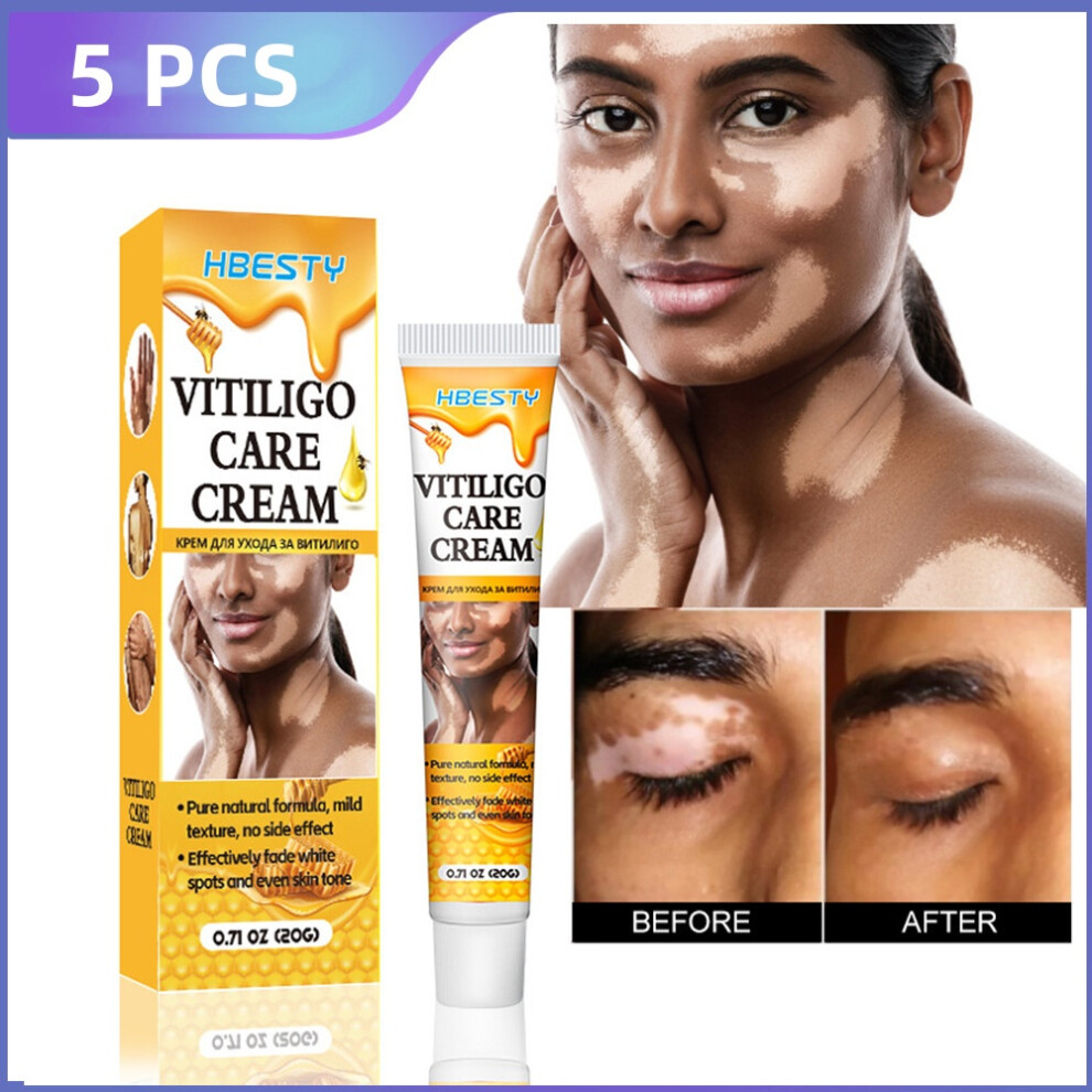 (5PCS) Vitiligo Cream for Skin Pigmentation Improvement - Reduces White Spots & Sweat Spot Piebald Appearance
