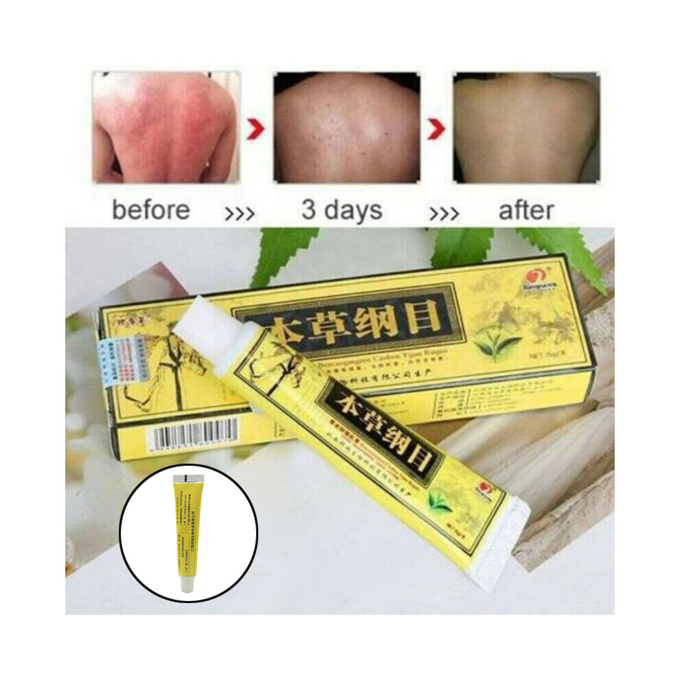Cream Chinese Herbal Itching Treatment Skin Body/Foot Allergy Ointment 15G